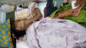 Kiki Fadila, Anak Yatim Umur 3,5 Tahun Derita Luka Bakar Disekujur Tubuh Pasca Alami Kebakaran Rumah.